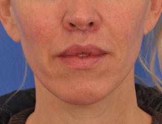 Lip Lift Before & After Gallery - Patient 336999 - Image 4