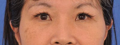 Blepharoplasty Before & After Gallery - Patient 110153 - Image 2