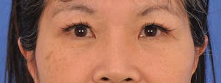Blepharoplasty Before & After Gallery - Patient 110153 - Image 2