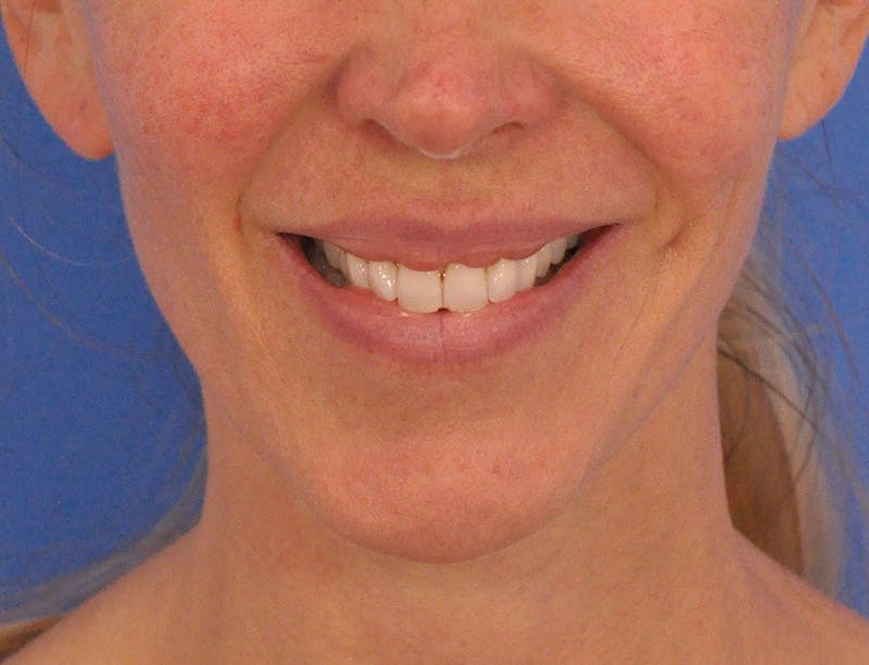 Lip Lift Before & After Gallery - Patient 336999 - Image 1