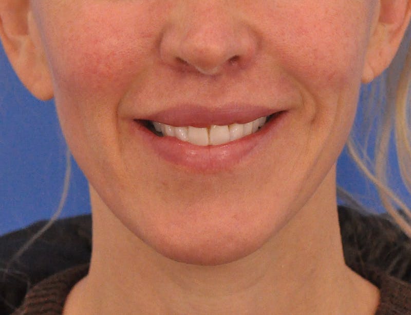 Lip Lift Before & After Gallery - Patient 336999 - Image 2