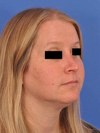 Rhinoplasty Before & After Gallery - Patient 157621 - Image 4
