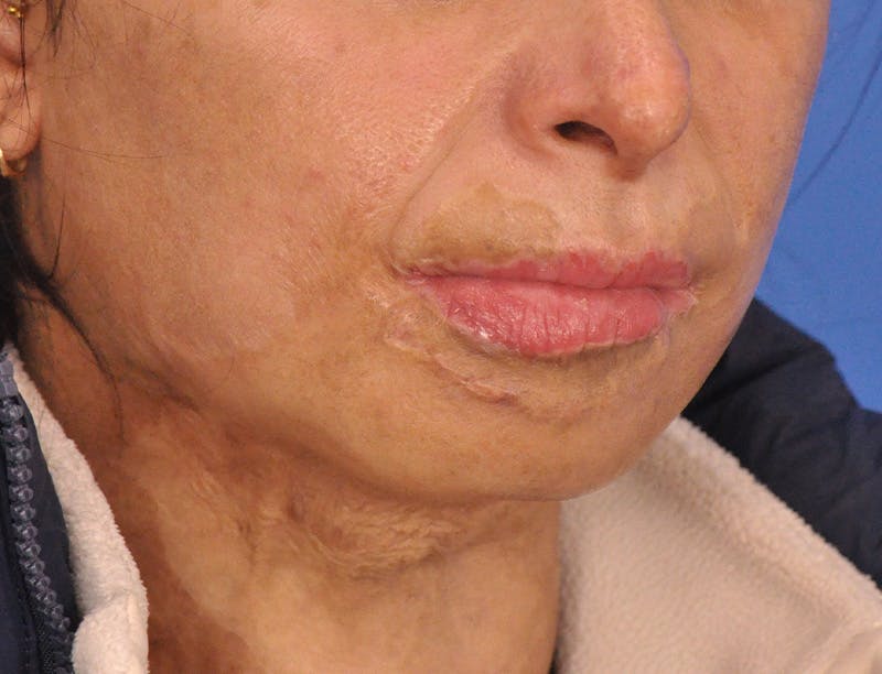 Lip Lift Before & After Gallery - Patient 380904 - Image 3