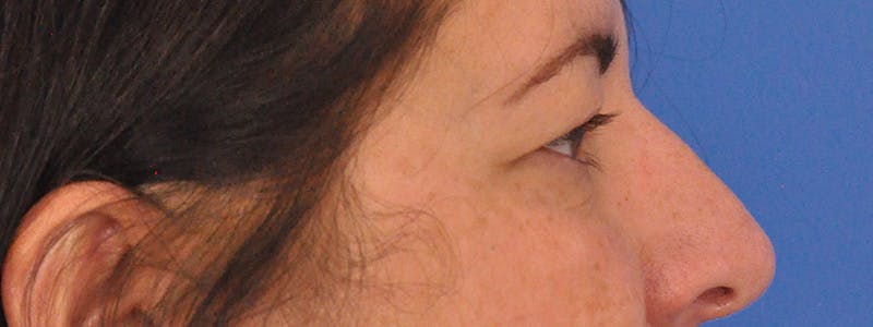 Blepharoplasty Before & After Gallery - Patient 378731 - Image 5