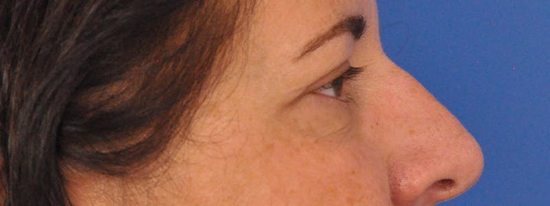 Blepharoplasty Before & After Gallery - Patient 378731 - Image 6