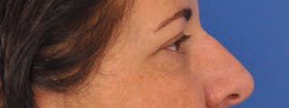 Blepharoplasty Before & After Gallery - Patient 378731 - Image 6
