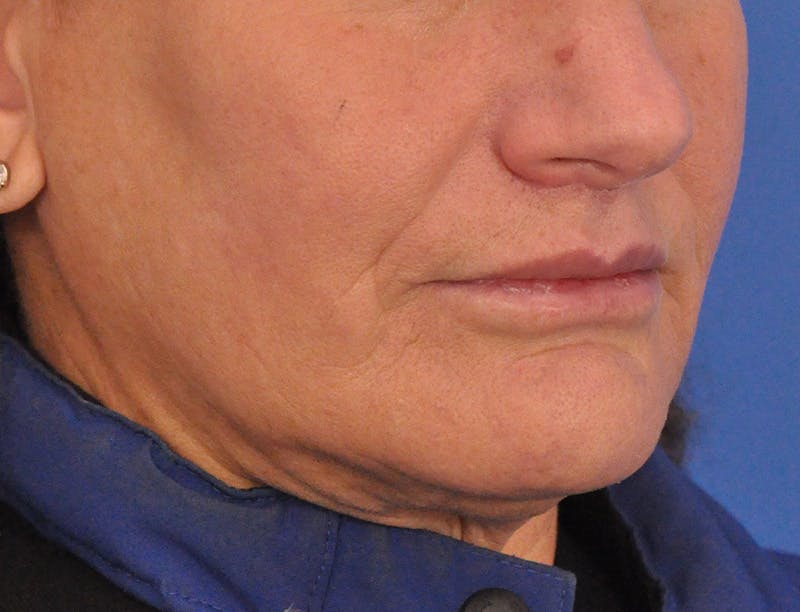 Lip Lift Before & After Gallery - Patient 271870 - Image 5