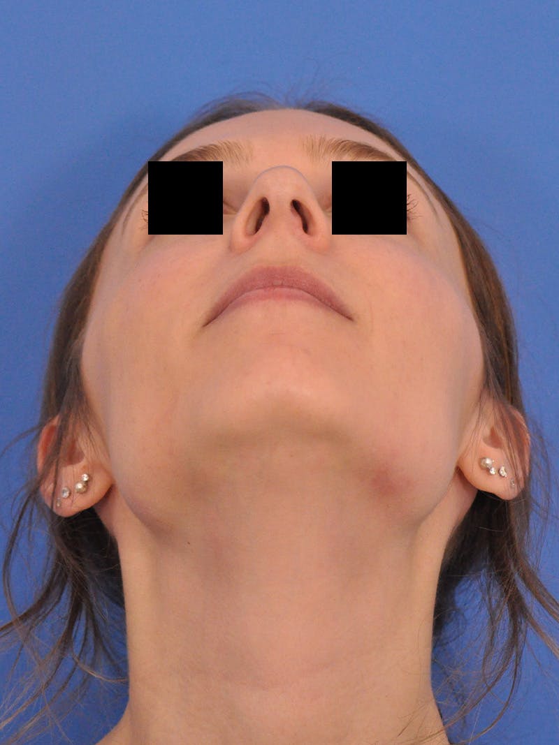 Rhinoplasty Before & After Gallery - Patient 230732 - Image 7