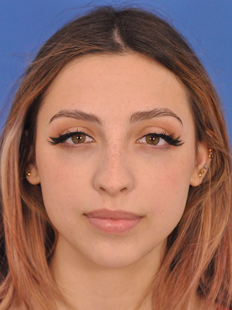 Rhinoplasty Before & After Gallery - Patient 192652 - Image 5