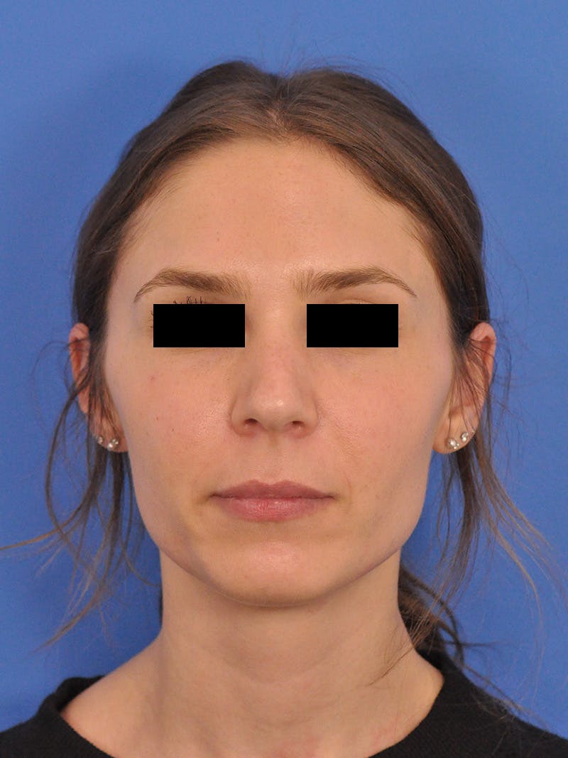 Rhinoplasty Before & After Gallery - Patient 230732 - Image 5