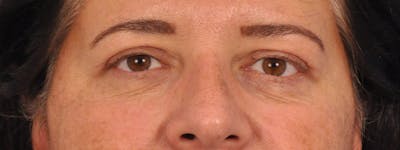 Blepharoplasty Before & After Gallery - Patient 378731 - Image 2