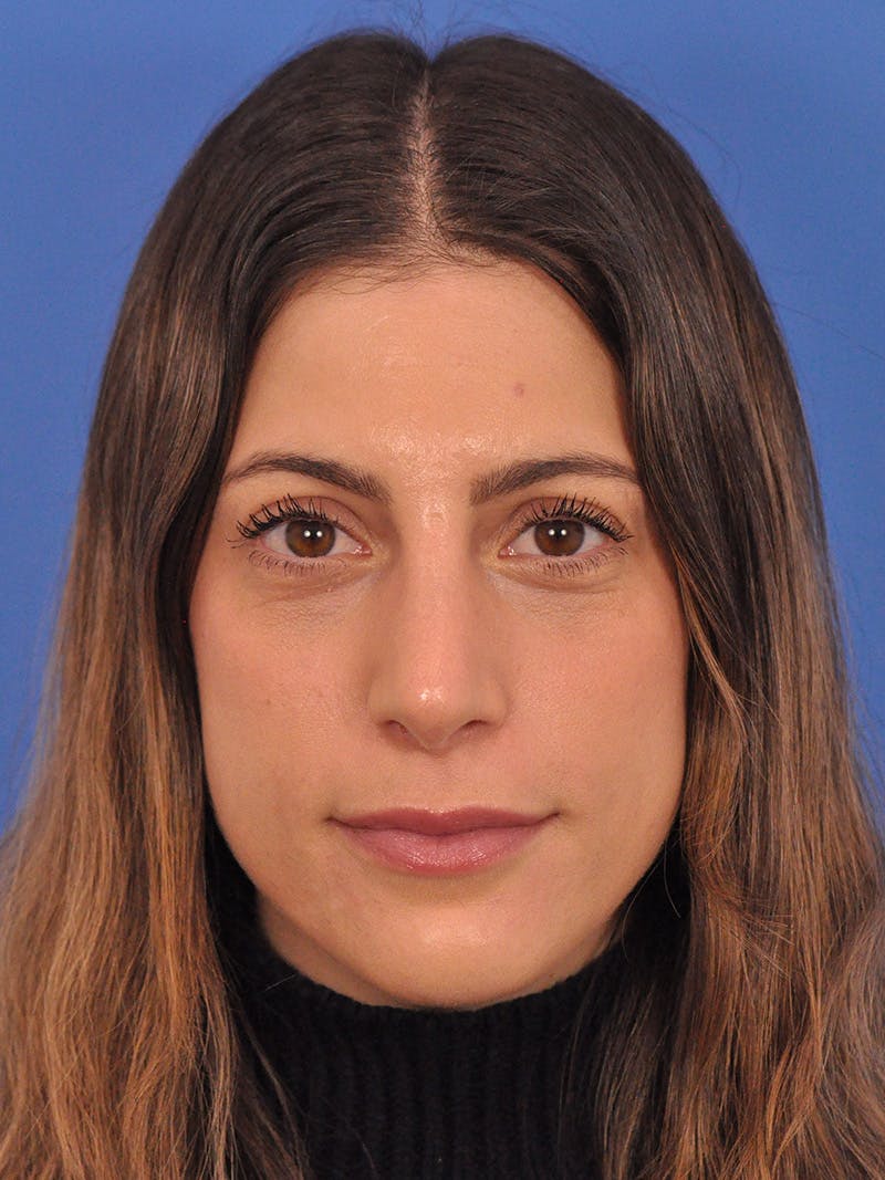 Rhinoplasty Before & After Gallery - Patient 574327 - Image 6