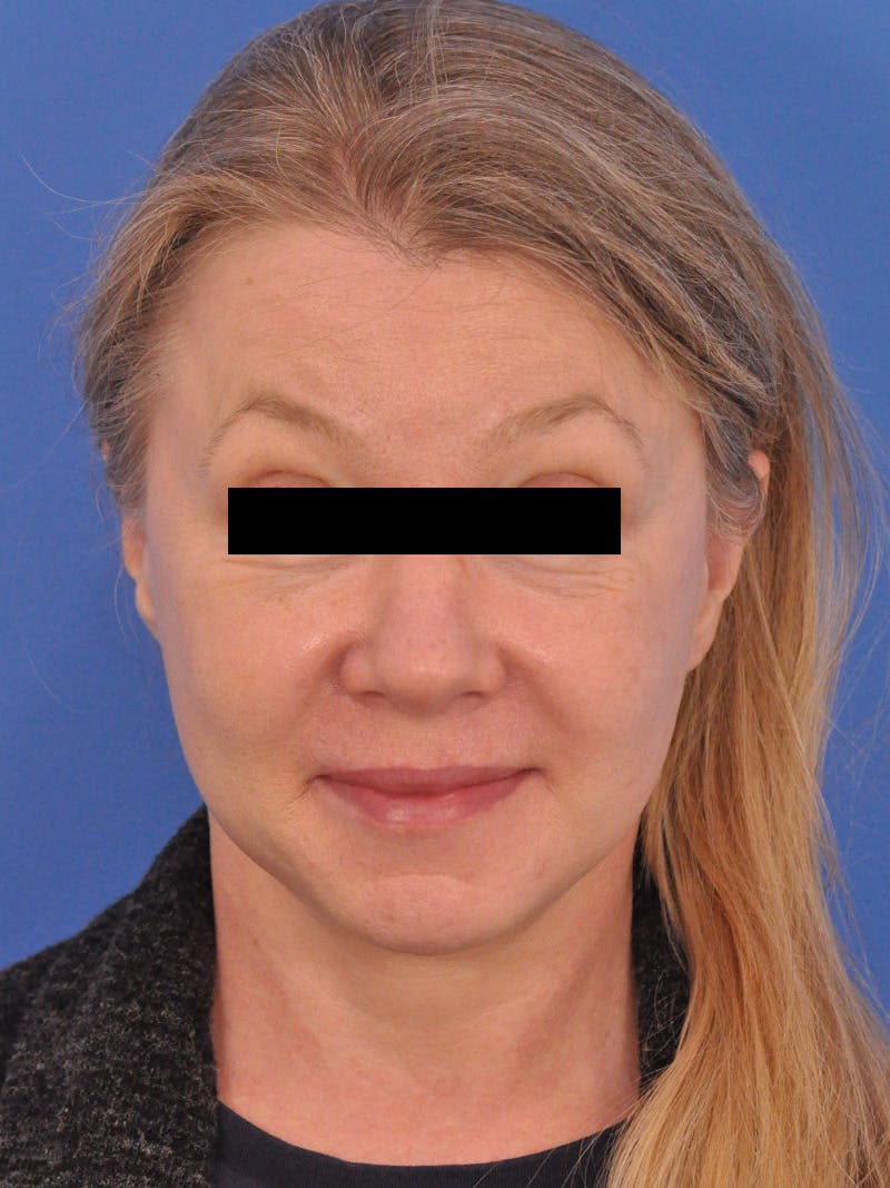 Facelift Before & After Gallery - Patient 202421 - Image 2