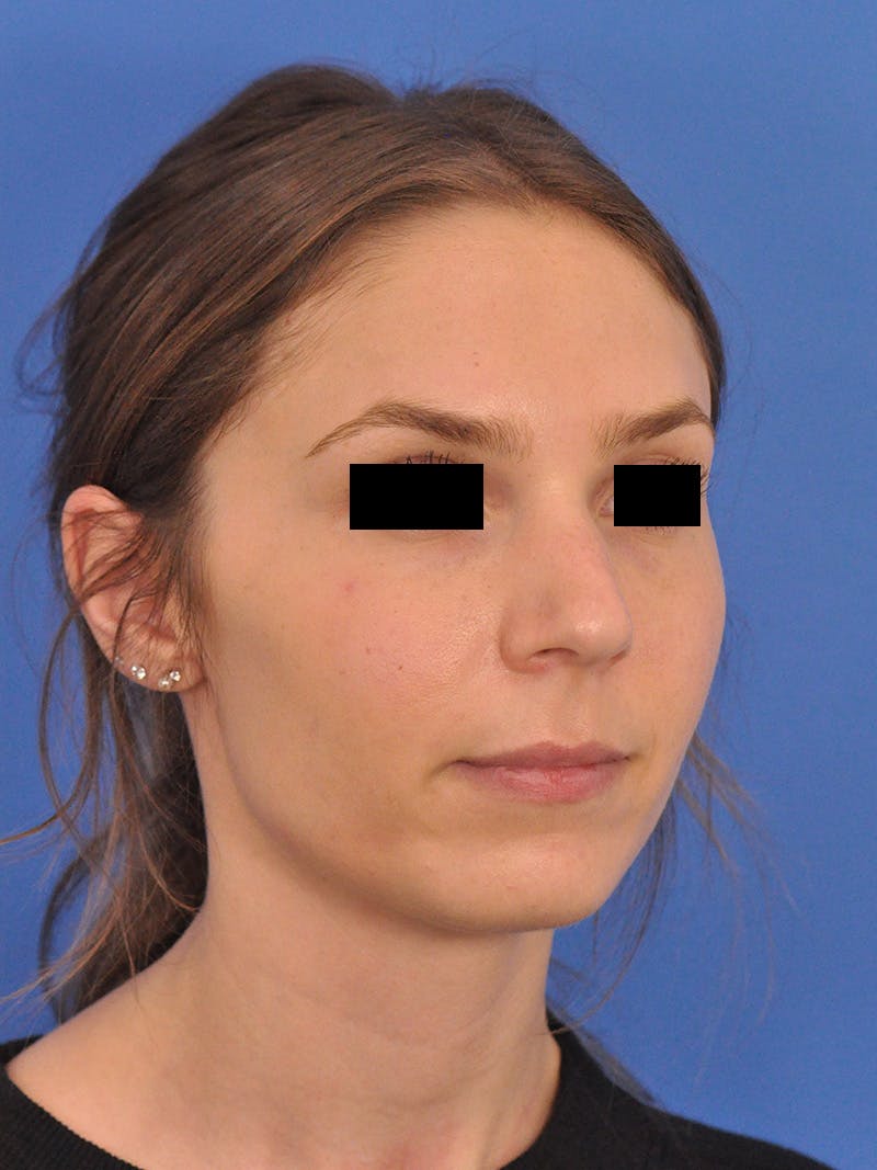 Rhinoplasty Before & After Gallery - Patient 230732 - Image 3