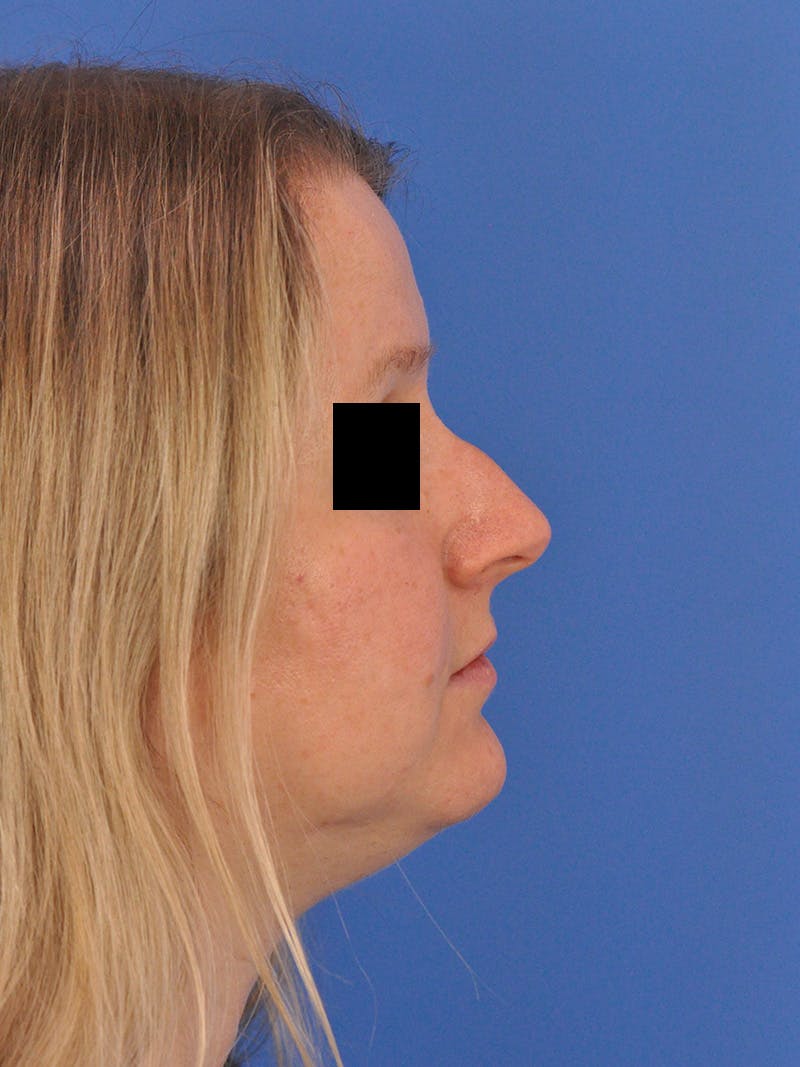 Rhinoplasty Before & After Gallery - Patient 157621 - Image 1
