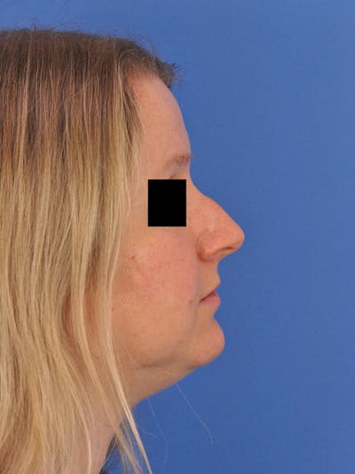 Rhinoplasty Before & After Gallery - Patient 157621 - Image 1