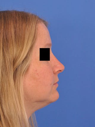 Rhinoplasty Before & After Gallery - Patient 157621 - Image 2
