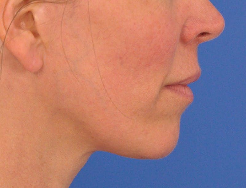 Lip Lift Before & After Gallery - Patient 336999 - Image 7