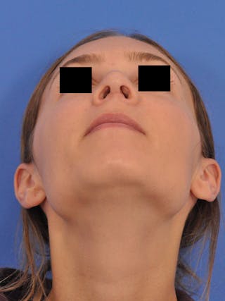 Rhinoplasty Before & After Gallery - Patient 230732 - Image 8