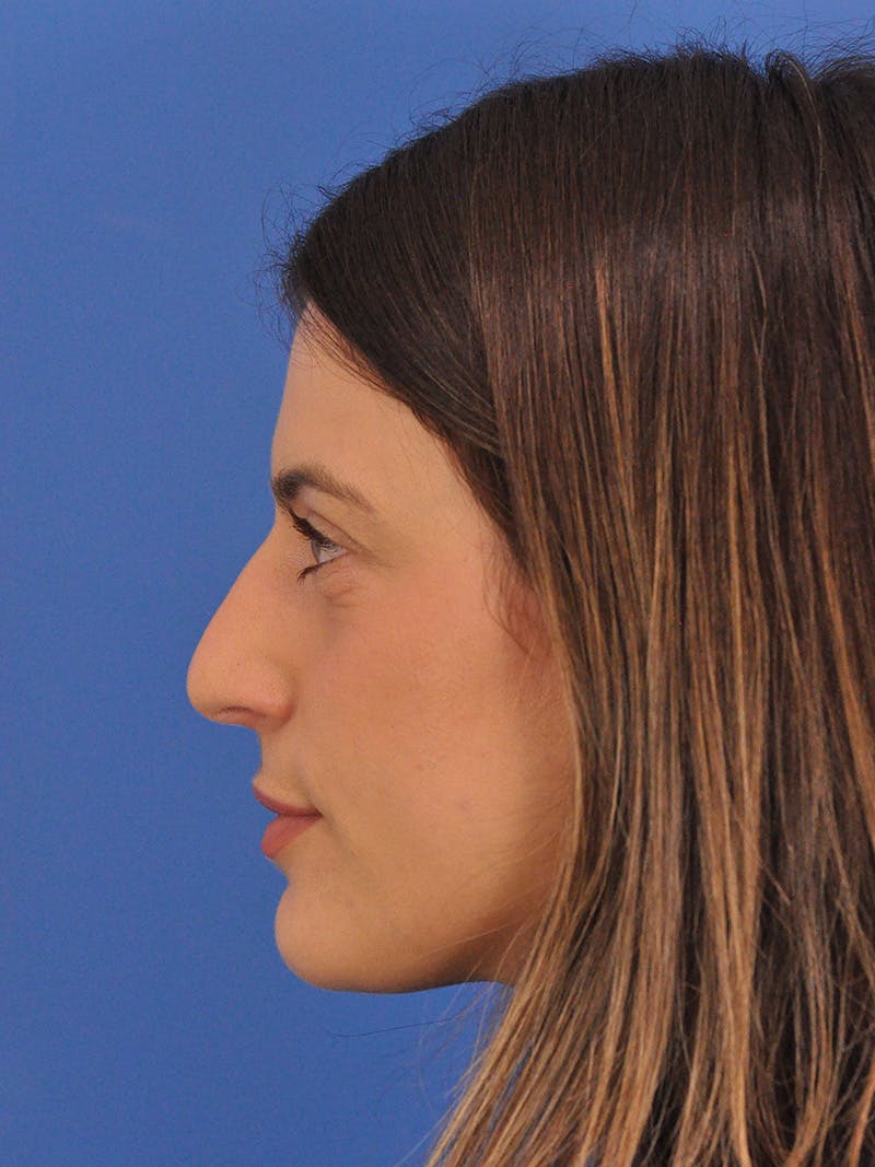 Rhinoplasty Before & After Gallery - Patient 574327 - Image 9