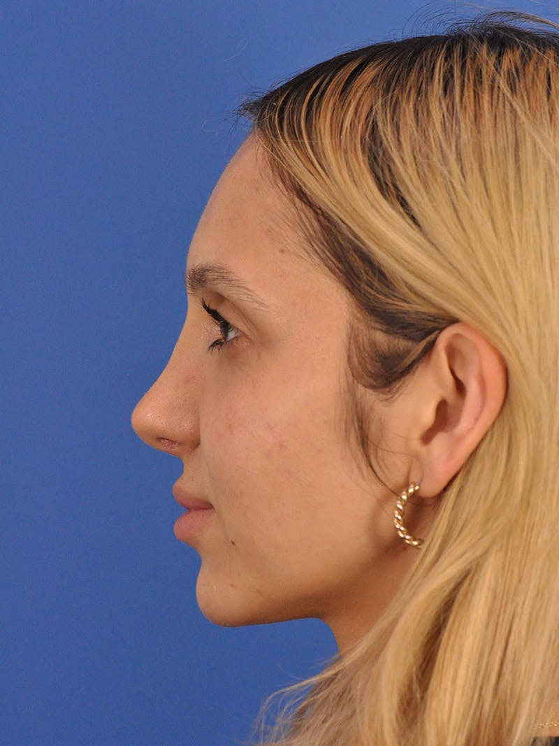 Rhinoplasty Before & After Gallery - Patient 587792 - Image 12