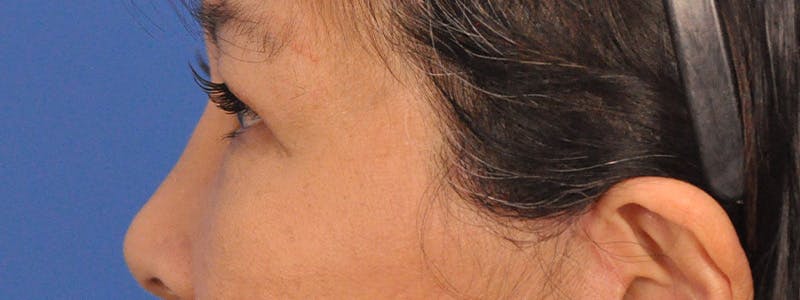 Blepharoplasty Before & After Gallery - Patient 110153 - Image 10
