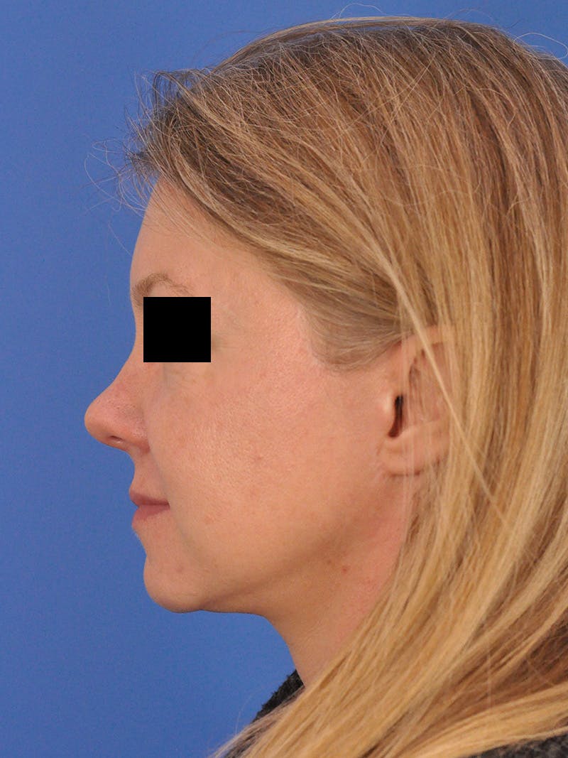 Facelift Before & After Gallery - Patient 202421 - Image 9