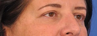 Blepharoplasty Before & After Gallery - Patient 378731 - Image 4