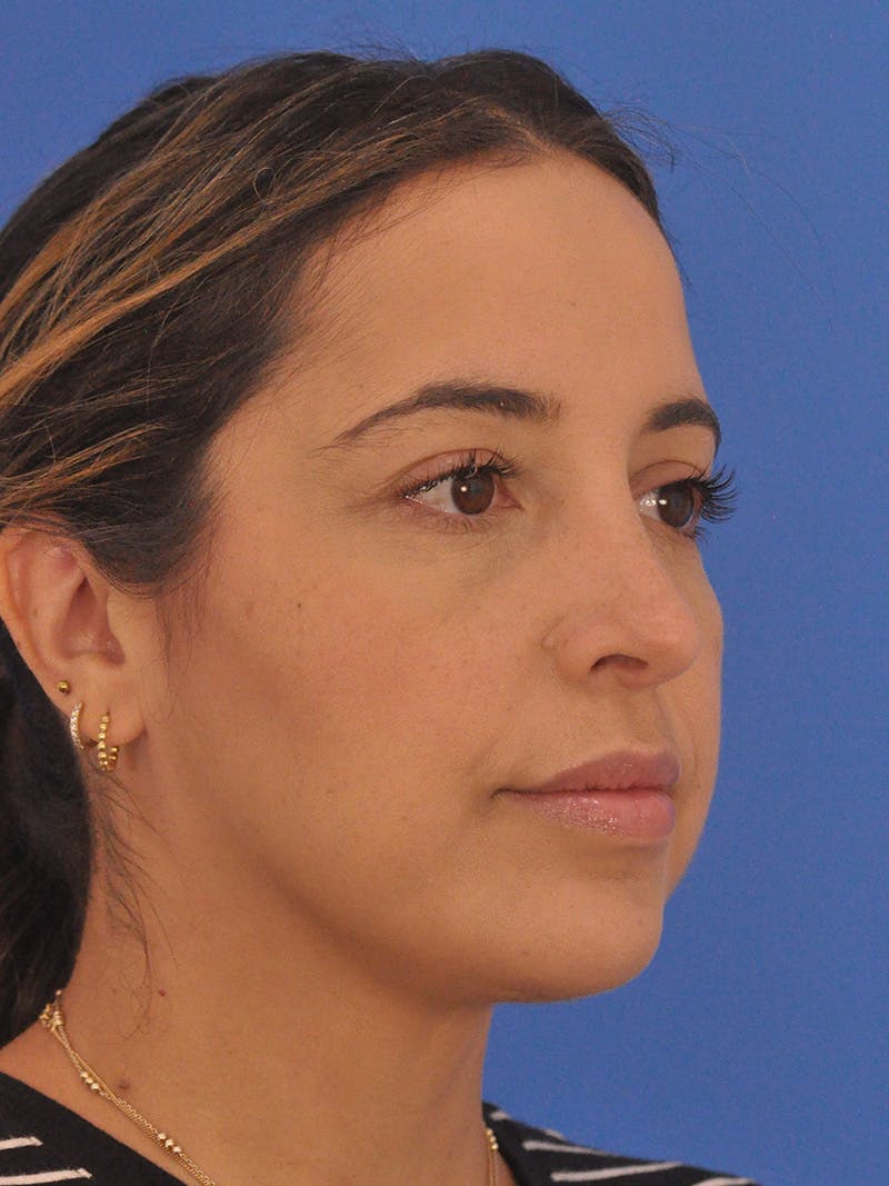 Rhinoplasty Before & After Gallery - Patient 277111 - Image 4