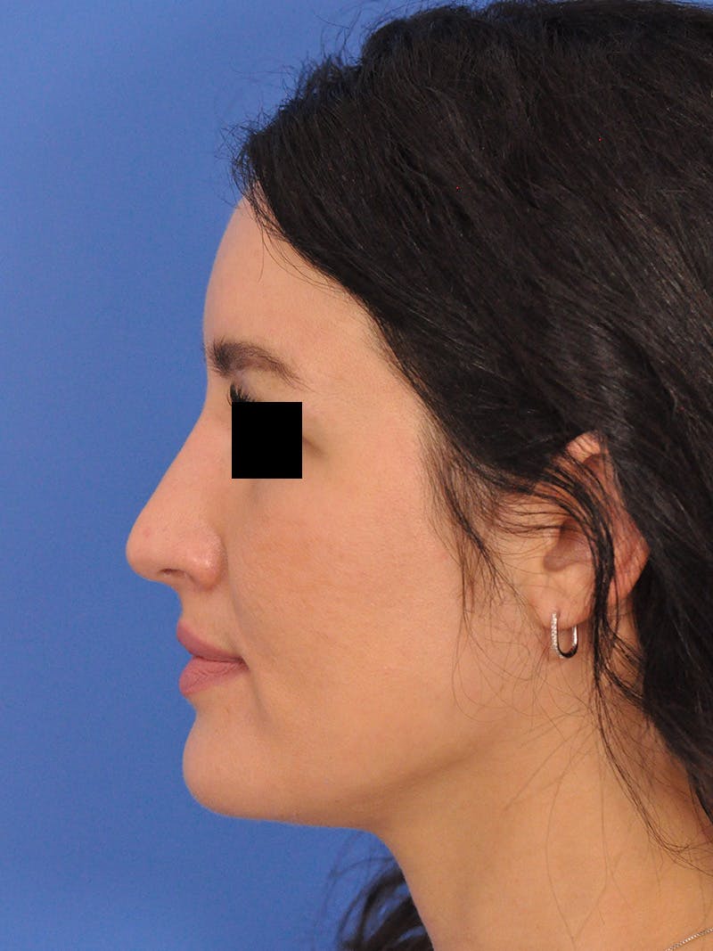 Brow Lift Before & After Gallery - Patient 233430 - Image 5