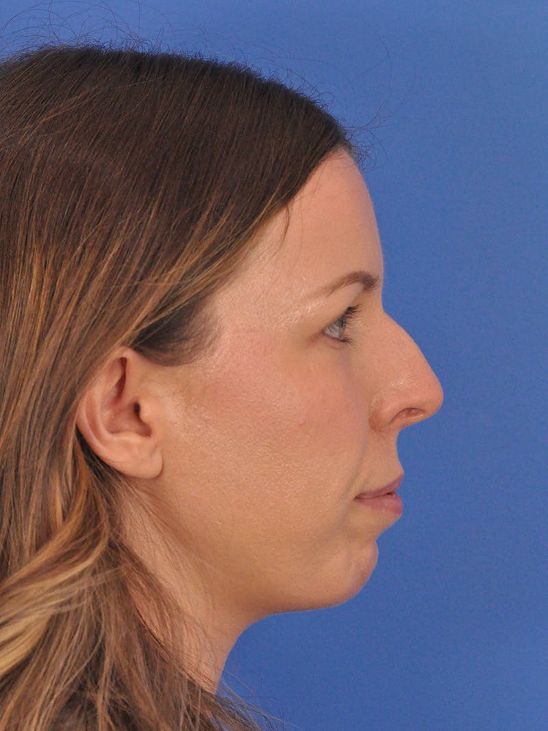 Rhinoplasty Before & After Gallery - Patient 135722 - Image 1