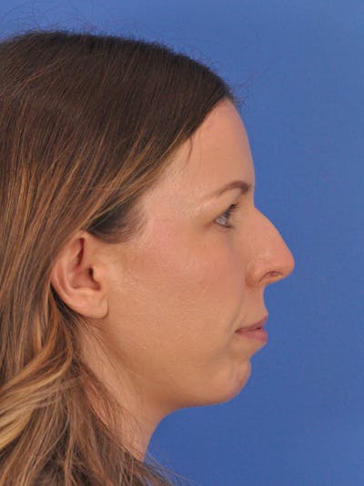 Rhinoplasty Before & After Gallery - Patient 135722 - Image 1