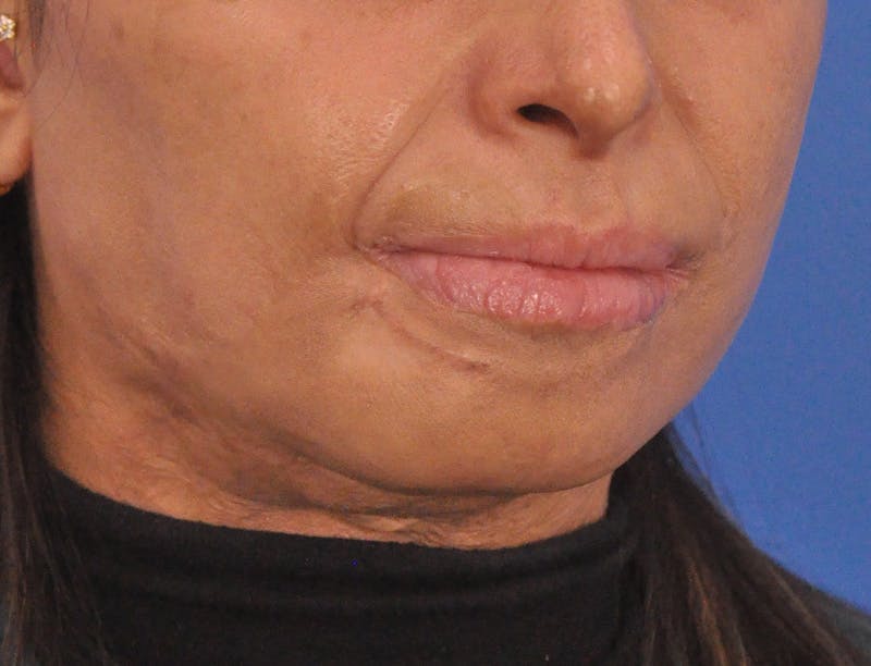 Lip Lift Before & After Gallery - Patient 380904 - Image 4
