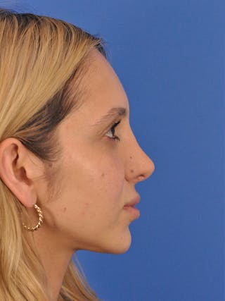 Rhinoplasty Before & After Gallery - Patient 587792 - Image 2