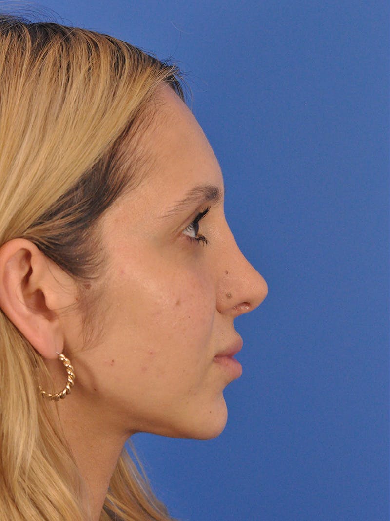 Rhinoplasty Before & After Gallery - Patient 587792 - Image 2