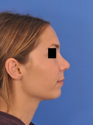Rhinoplasty Before & After Gallery - Patient 230732 - Image 2
