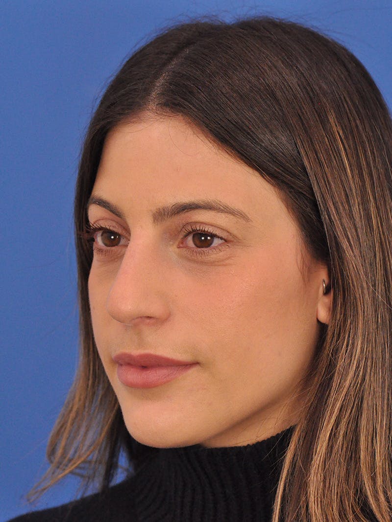 Rhinoplasty Before & After Gallery - Patient 574327 - Image 8