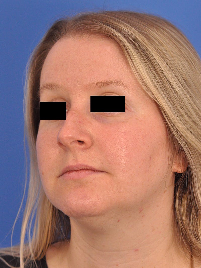 Rhinoplasty Before & After Gallery - Patient 157621 - Image 7