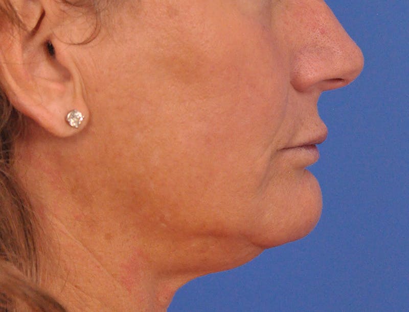 Lip Lift Before & After Gallery - Patient 271870 - Image 7
