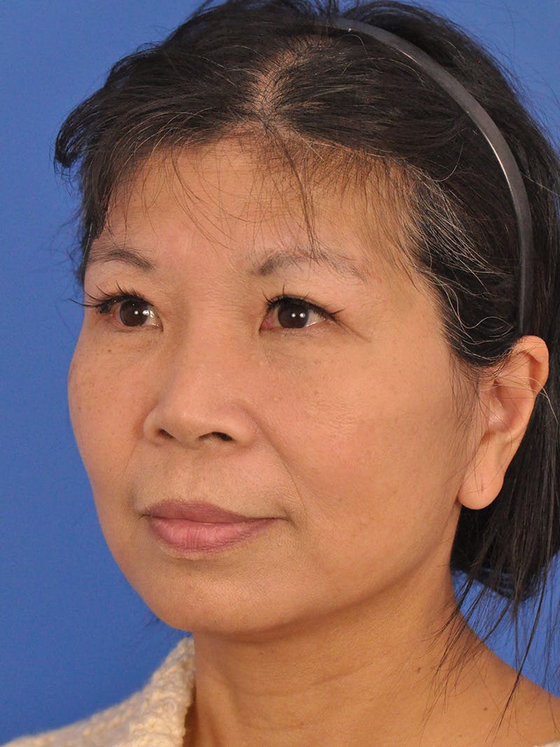 Facelift Before & After Gallery - Patient 227711 - Image 8