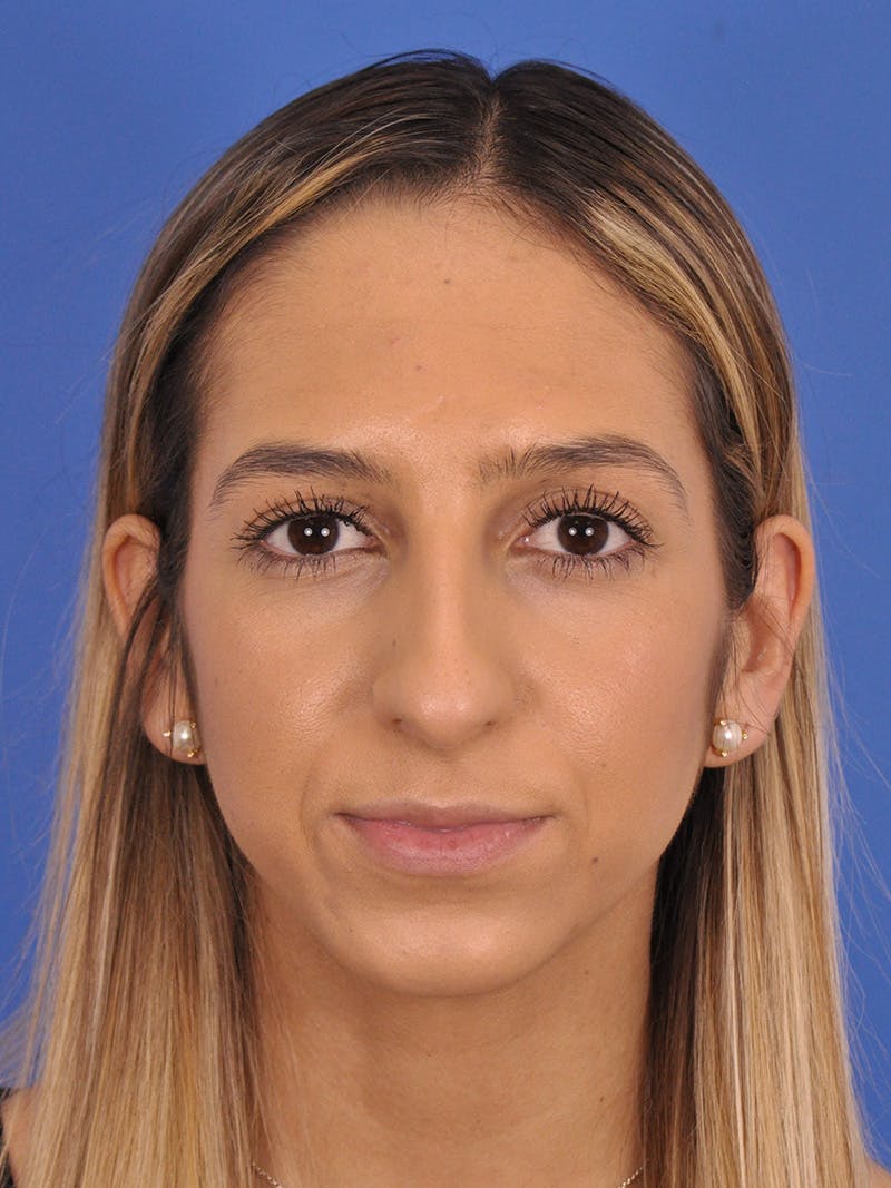 Rhinoplasty Before & After Gallery - Patient 587792 - Image 5