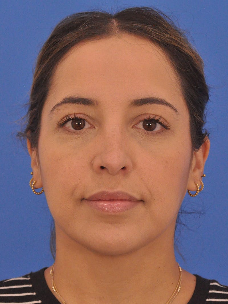 Rhinoplasty Before & After Gallery - Patient 277111 - Image 6