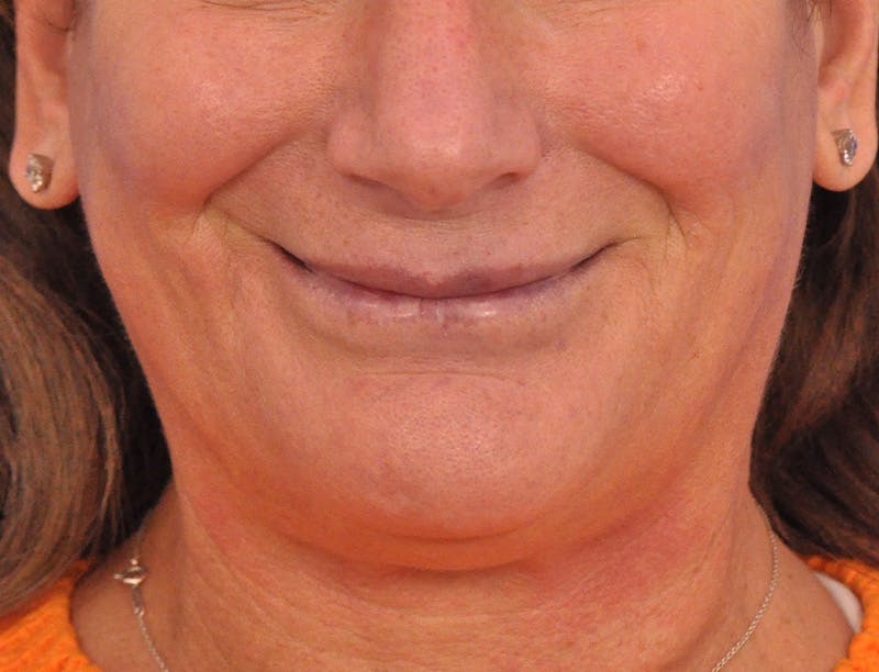 Lip Lift Before & After Gallery - Patient 271870 - Image 3