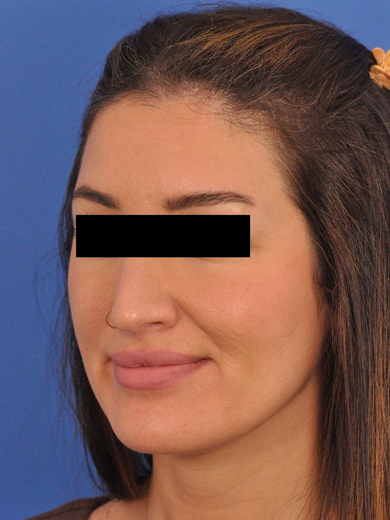 Brow Lift Before & After Gallery - Patient 233430 - Image 4
