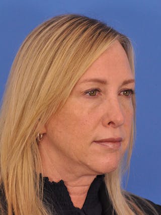 Rhinoplasty Before & After Gallery - Patient 315321 - Image 4