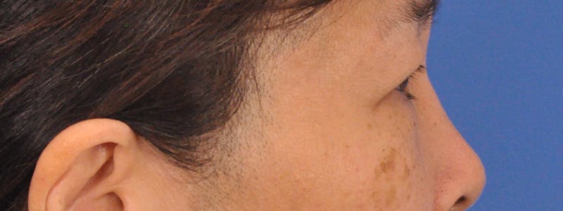 Blepharoplasty Before & After Gallery - Patient 110153 - Image 5