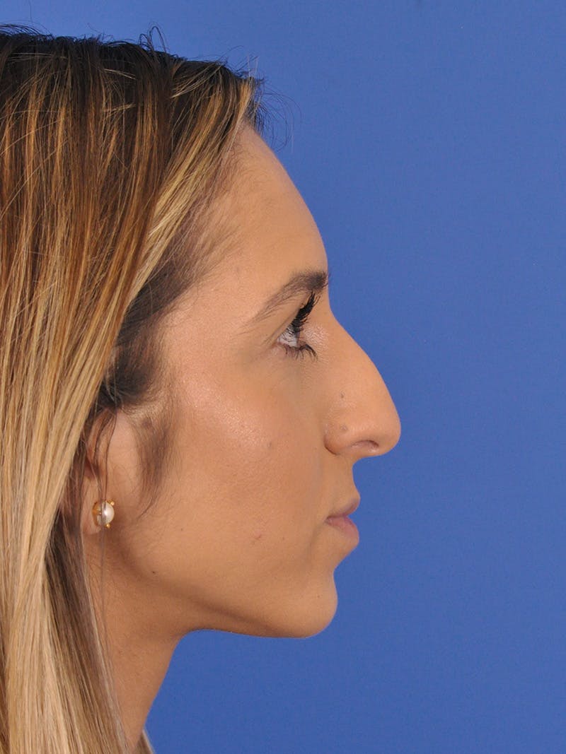 Rhinoplasty Before & After Gallery - Patient 587792 - Image 1