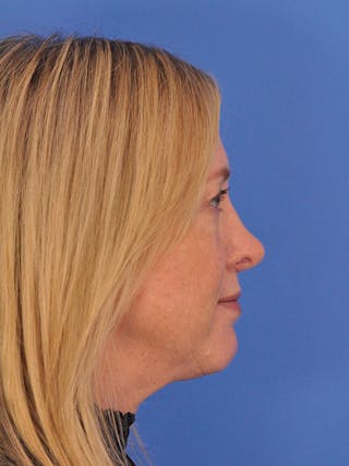 Rhinoplasty Before & After Gallery - Patient 315321 - Image 2