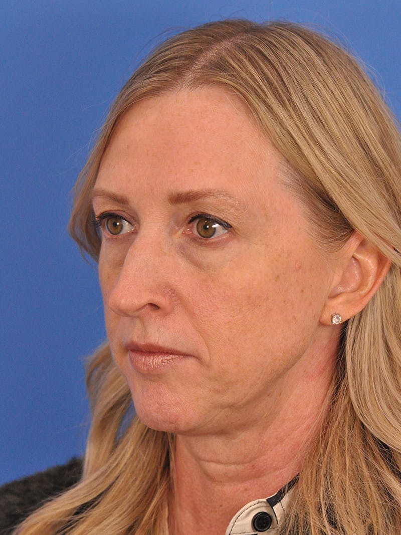 Rhinoplasty Before & After Gallery - Patient 315321 - Image 9