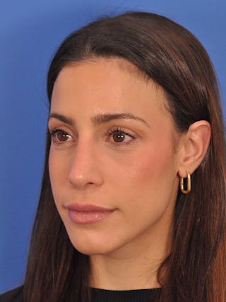 Rhinoplasty Before & After Gallery - Patient 100951 - Image 8